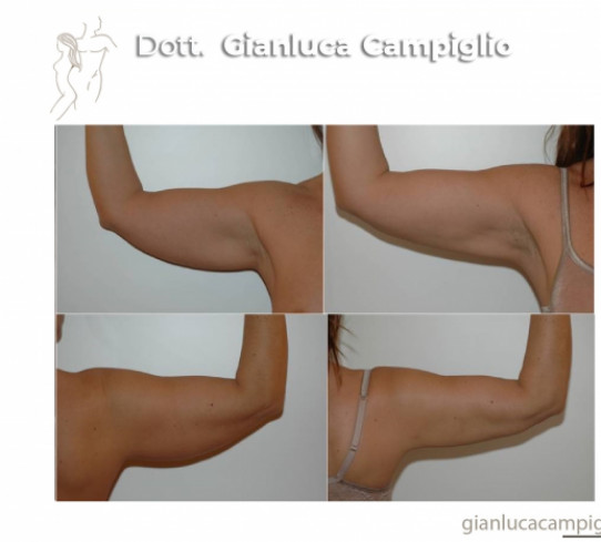 Liposuzione braccia Milano Dott. Gianluca Campiglio